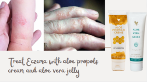 eczema, sunburn, allergies, aloe vera, aloe era gel